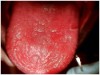 Figure 2â€‚ Deeply fissured tongue often seen in patients with xerostomia.