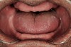 Figure 23  Advanced Triad, Retracted tongue position in edentulous patients limits the available airway. Wearing their dentures at night may allow for a more favorable airway.