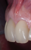 Fig 10. Oblique view of single-tooth implant No. 8 (1:1) treated with PET. Note the excellent retention of soft-tissue form around the restoration reflecting maintenance of the supporting buccal plate of bone.