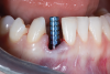 Fig 12. Implant placement No. 27 (4:3) after preparation of the root for PET protocol, demonstrating the ability to ideally place the implant within the newly prepared PET socket and maintain the integrity of the surrounding soft tissues.