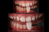 Fig 2. Top panel: Pretreatment situation of adolescent patient. Bottom panel: After 2 weeks of at-home teeth-bleaching treatment utilizing 10%
carbamide peroxide in custom trays (Pola Night, SDI), the patient has achieved a final result that is six shades brighter than the baseline shade.